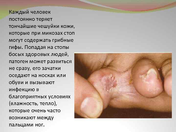 Каждый человек постоянно теряет тончайшие чешуйки кожи, которые при микозах стоп могут содержать грибные