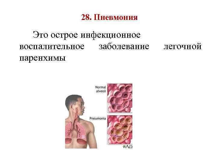 28. Пневмония Это острое инфекционное воспалительное заболевание паренхимы легочной 