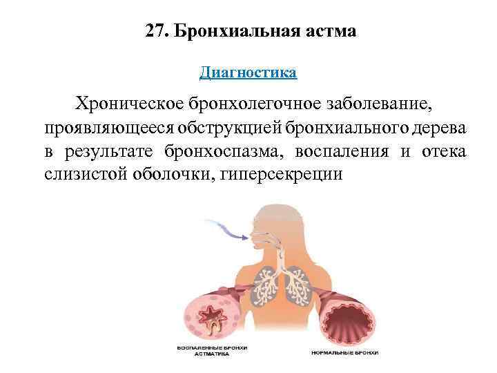  27. Бронхиальная астма Диагностика Хроническое бронхолегочное заболевание, проявляющееся обструкцией бронхиального дерева в результате