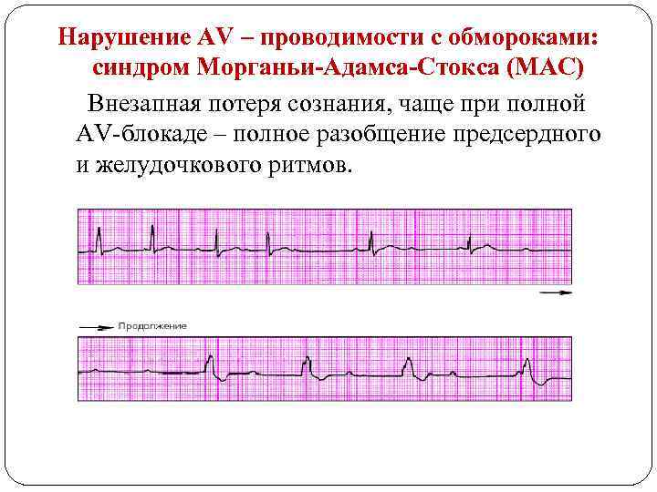 Нарушение АV – проводимости с обмороками: синдром Морганьи-Адамса-Стокса (МАС) Внезапная потеря сознания, чаще при