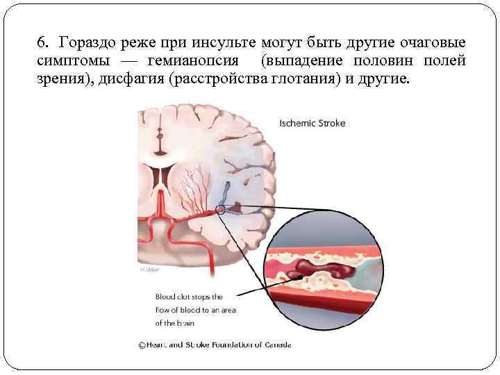 Церебральная микроангиопатия головного мозга что это