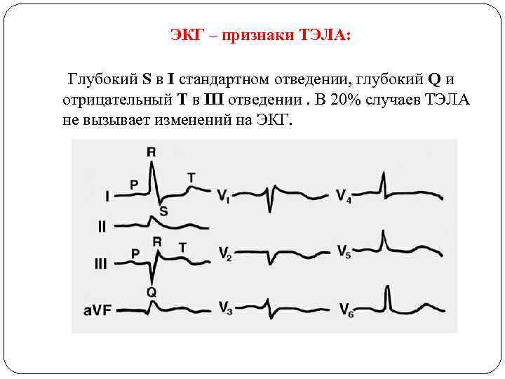 ЭКГ – признаки ТЭЛА: Глубокий S в I стандартном отведении, глубокий Q и отрицательный