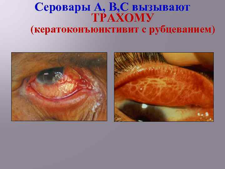 Серовары А, В, С вызывают ТРАХОМУ (кератоконъюнктивит с рубцеванием) 