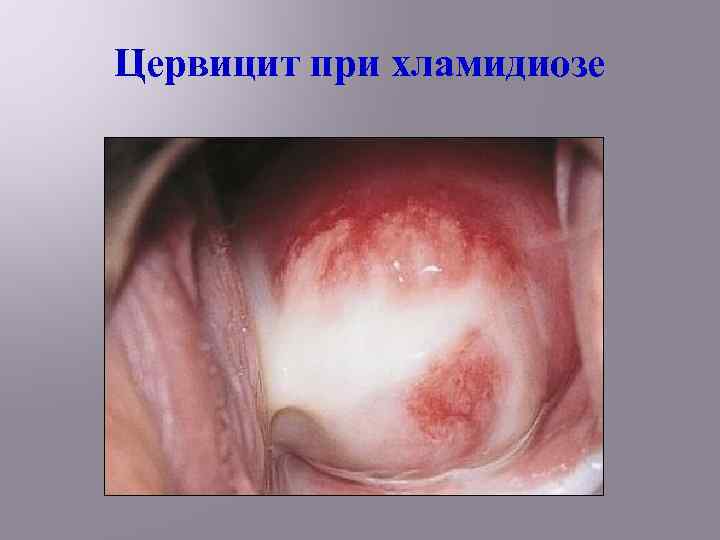 Цервицит при хламидиозе 