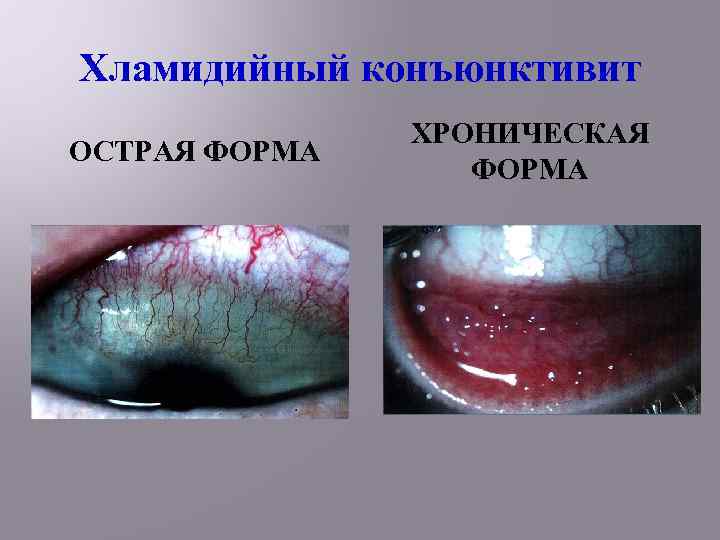 Хламидийный конъюнктивит ОСТРАЯ ФОРМА ХРОНИЧЕСКАЯ ФОРМА 