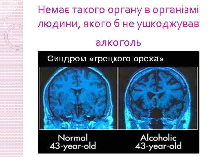 Немає такого органу в організмі людини, якого б не ушкоджував алкоголь 