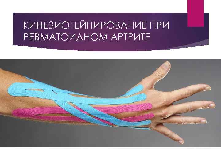 КИНЕЗИОТЕЙПИРОВАНИЕ ПРИ РЕВМАТОИДНОМ АРТРИТЕ 