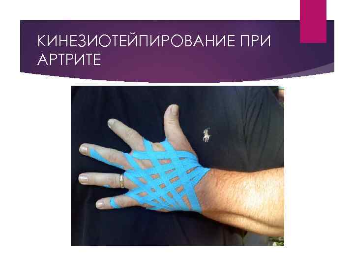 КИНЕЗИОТЕЙПИРОВАНИЕ ПРИ АРТРИТЕ 