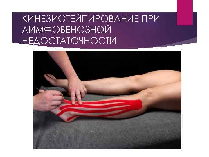 КИНЕЗИОТЕЙПИРОВАНИЕ ПРИ ЛИМФОВЕНОЗНОЙ НЕДОСТАТОЧНОСТИ 