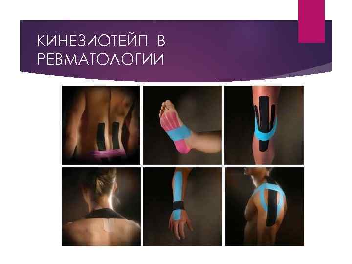 КИНЕЗИОТЕЙП В РЕВМАТОЛОГИИ 