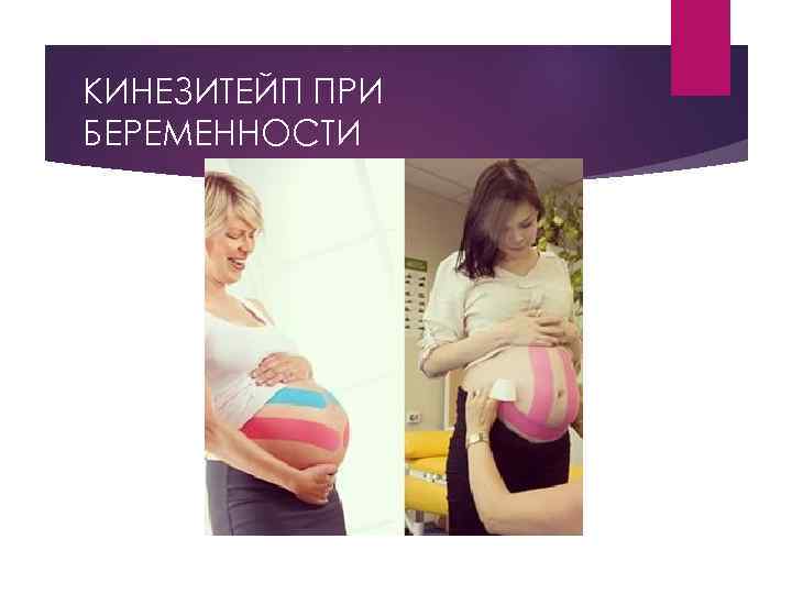 КИНЕЗИТЕЙП ПРИ БЕРЕМЕННОСТИ 