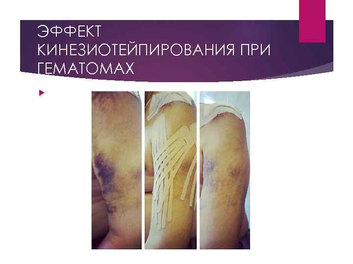ЭФФЕКТ КИНЕЗИОТЕЙПИРОВАНИЯ ПРИ ГЕМАТОМАХ 
