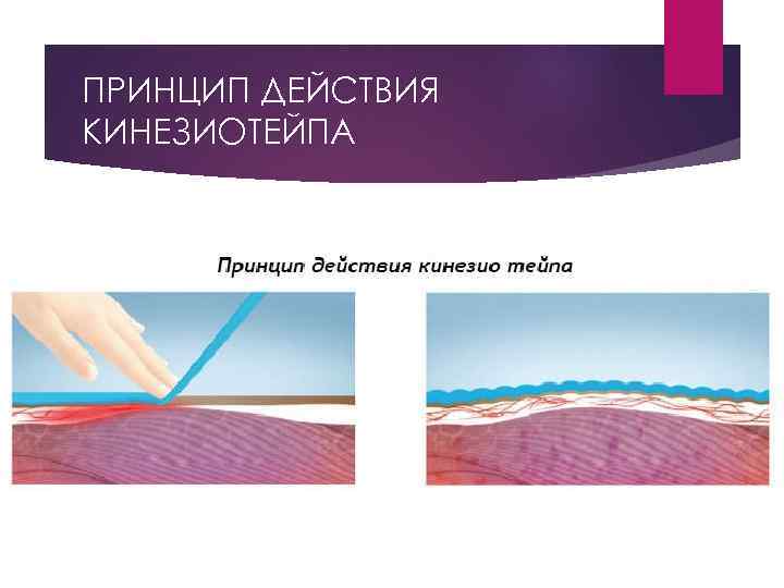 ПРИНЦИП ДЕЙСТВИЯ КИНЕЗИОТЕЙПА 
