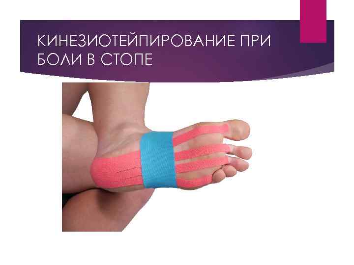 КИНЕЗИОТЕЙПИРОВАНИЕ ПРИ БОЛИ В СТОПЕ 
