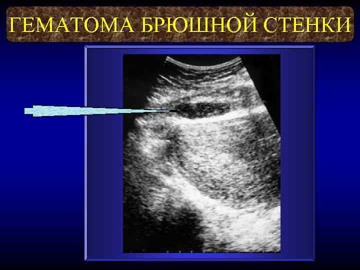 ГЕМАТОМА БРЮШНОЙ СТЕНКИ 