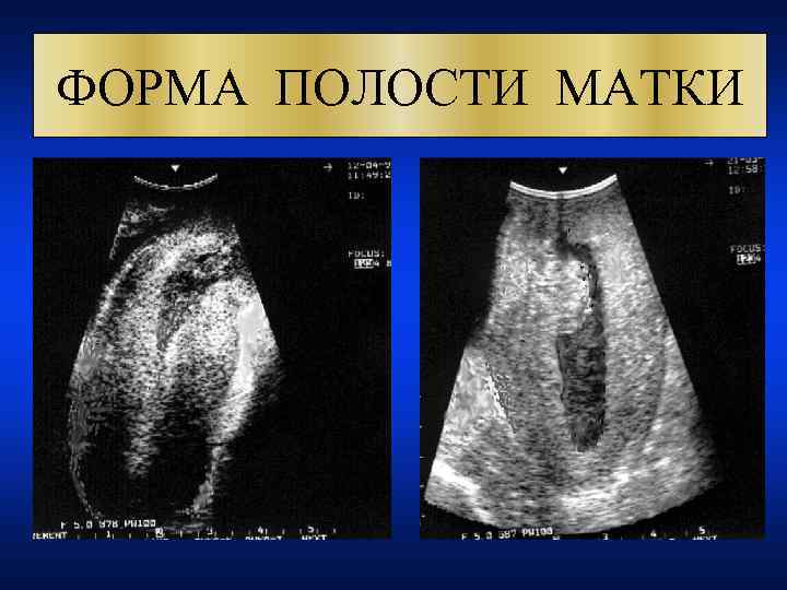 ФОРМА ПОЛОСТИ МАТКИ 