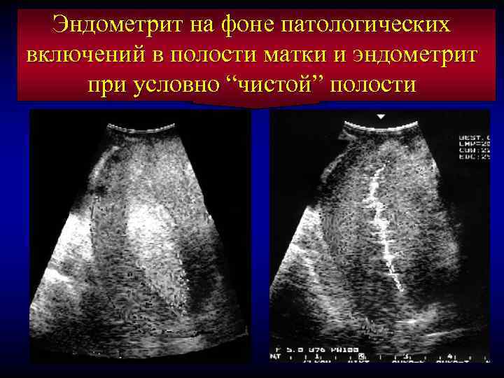 Эндометрит на фоне патологических включений в полости матки и эндометрит при условно “чистой” полости