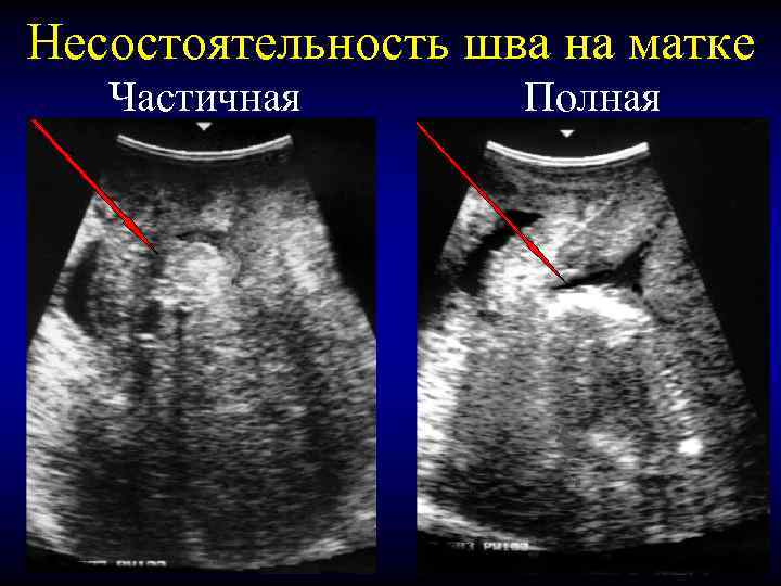 Несостоятельность шва на матке Частичная Полная 