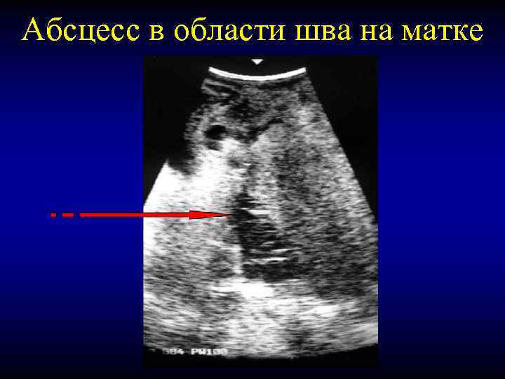 Абсцесс в области шва на матке 