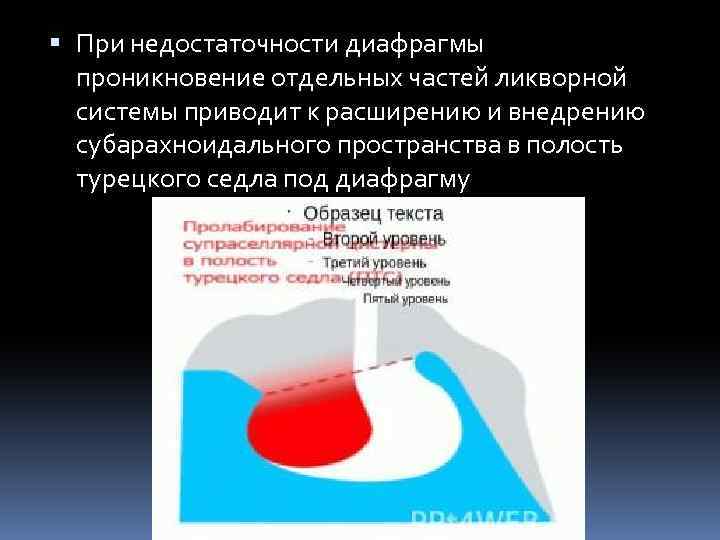  При недостаточности диафрагмы проникновение отдельных частей ликворной системы приводит к расширению и внедрению