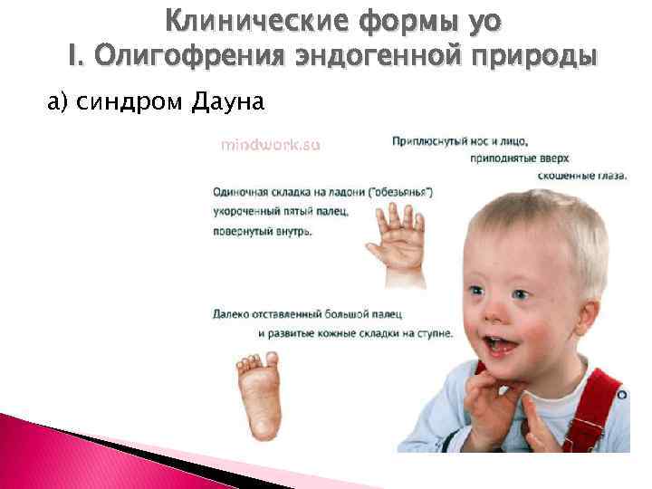 Клинические формы уо I. Олигофрения эндогенной природы а) синдром Дауна 