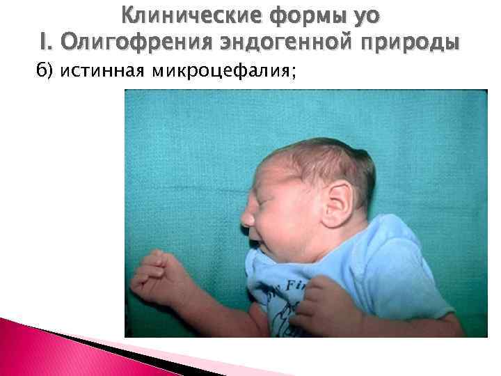 Клинические формы уо I. Олигофрения эндогенной природы б) истинная микроцефалия; 