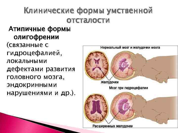  Клинические формы умственной отсталости Атипичные формы олигофрении (связанные с гидроцефалией, локальными дефектами развития