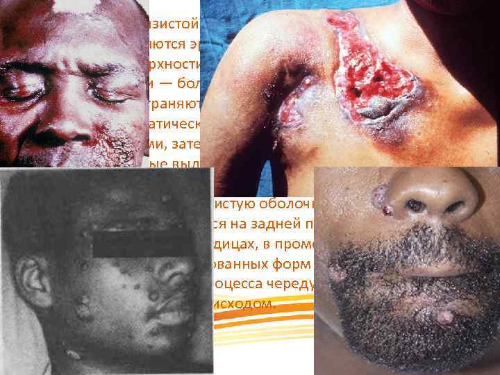 При поражении слизистой оболочки полости рта чаще на миндалинах появляются эрозивные очаги неправильных очертаний,