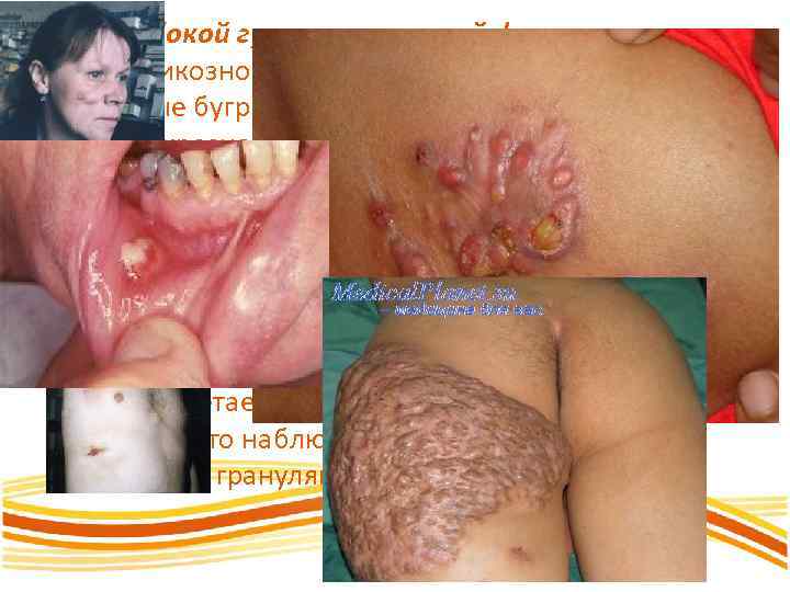 При глубокой гуммозно-узловой форме актиномикозного поражения кожи образуются скученные бугристые, чрезвычайно плотные узлы багрово