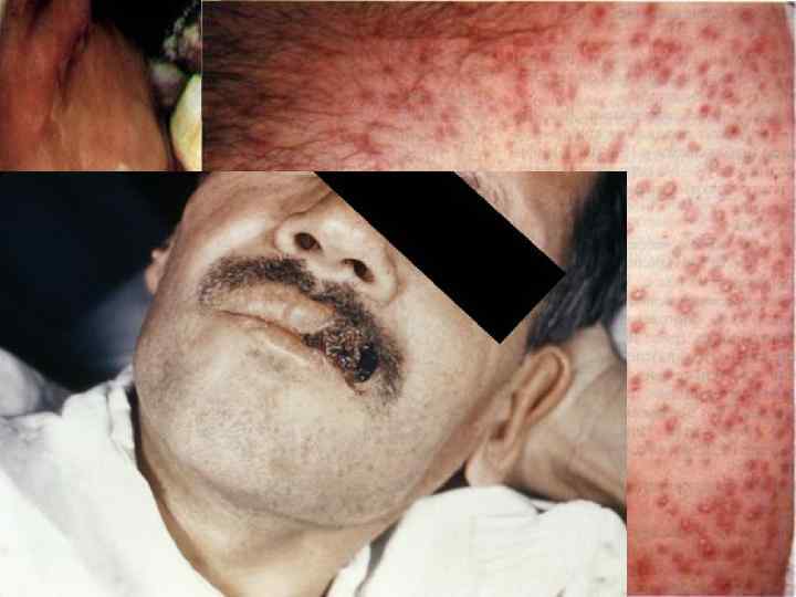  • У 50% больных гистоплазмозом отмечается поражение кожи; на ней возникают узлы различных