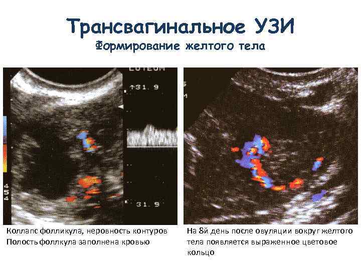 Трансвагинальное УЗИ Формирование желтого тела Коллапс фолликула, неровность контуров Полость фоллкула заполнена кровью На