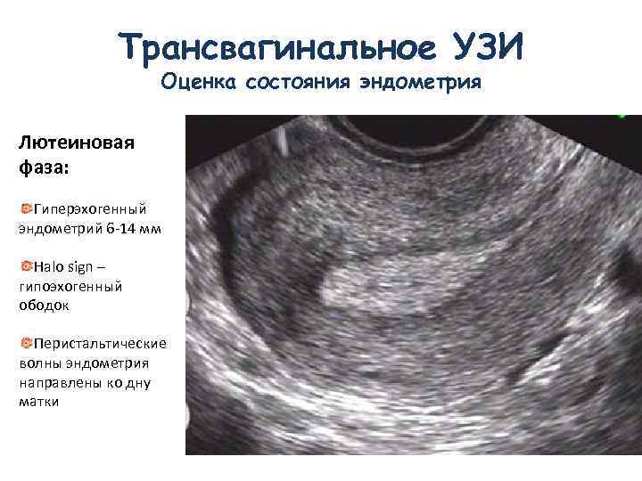 Эндометрий 4 1. Атипическая гиперплазия эндометрия УЗИ. Гиперэхогенный полип эндометрия.