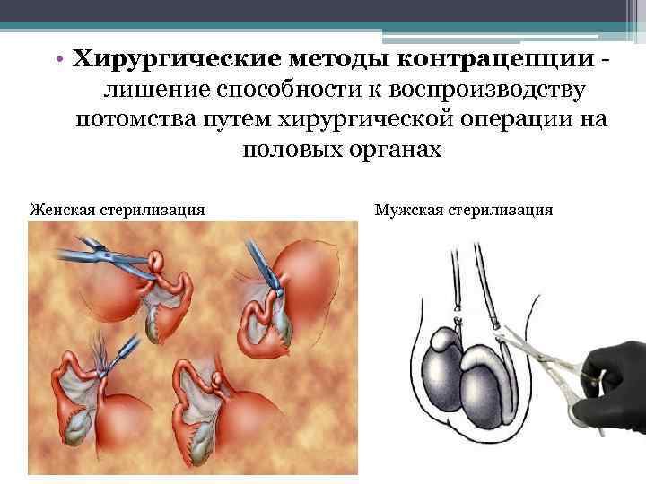  • Хирургические методы контрацепции лишение способности к воспроизводству потомства путем хирургической операции на