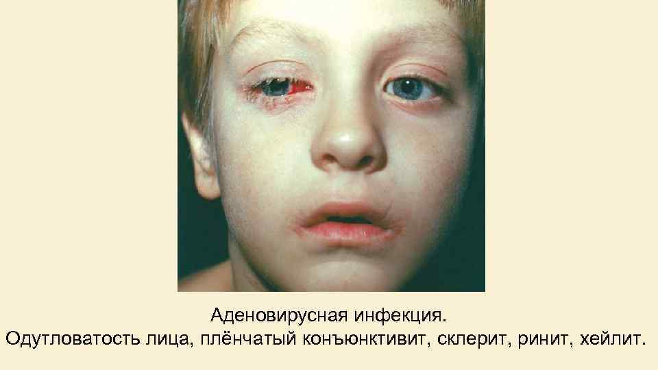 Аденовирусная инфекция. Одутловатость лица, плёнчатый конъюнктивит, склерит, ринит, хейлит. 