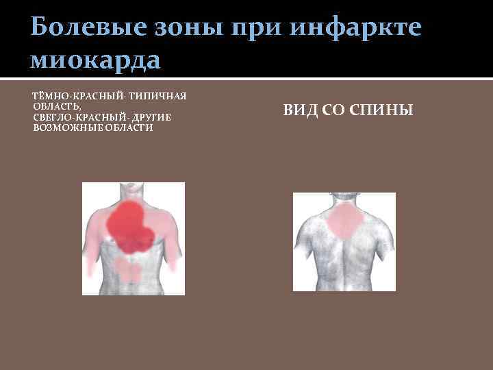 Болевые зоны при инфаркте миокарда ТЁМНО-КРАСНЫЙ- ТИПИЧНАЯ ОБЛАСТЬ, СВЕТЛО-КРАСНЫЙ- ДРУГИЕ ВОЗМОЖНЫЕ ОБЛАСТИ ВИД СО