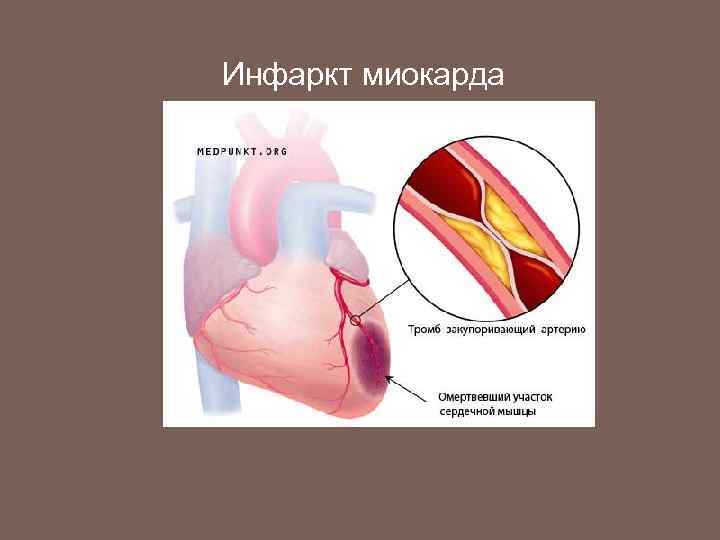 Инфаркт миокарда 