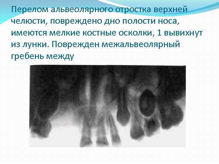 Перелом альвеолярного отростка верхней челюсти, повреждено дно полости носа, имеются мелкие костные осколки, 1