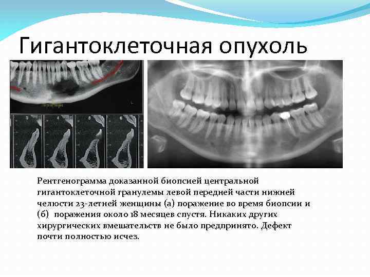 Клиническая картина периферической гигантоклеточной гранулемы характеризуется