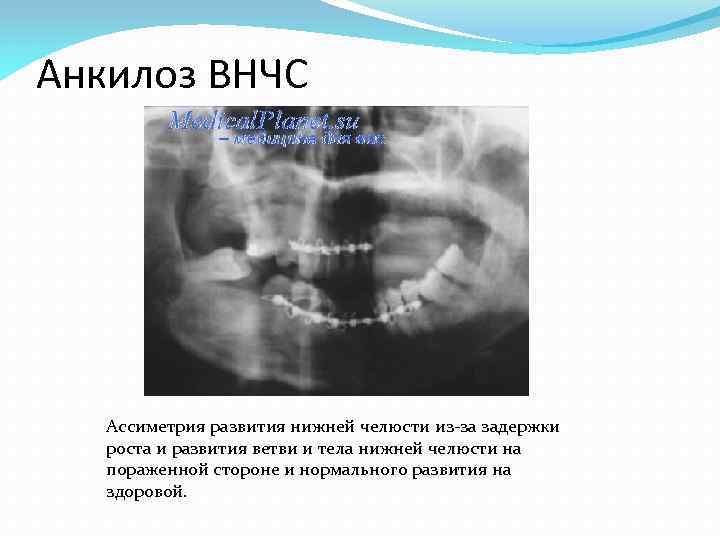 Анкилоз челюсти