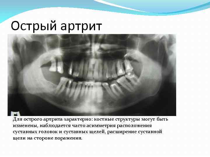 Острый артрит Для острого артрита характерно: костные структуры могут быть изменены, наблюдается часто асимметрия