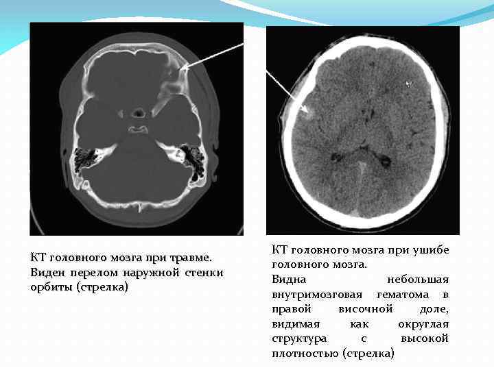 Перелом наружной стенки орбиты