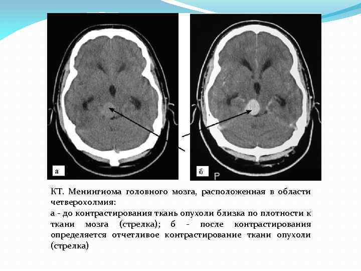 Объемное образование головного мозга код. Менингиомы головного мозга на кт. Петрифицированная менингиома. Кальцинированная менингиома лобной доли.