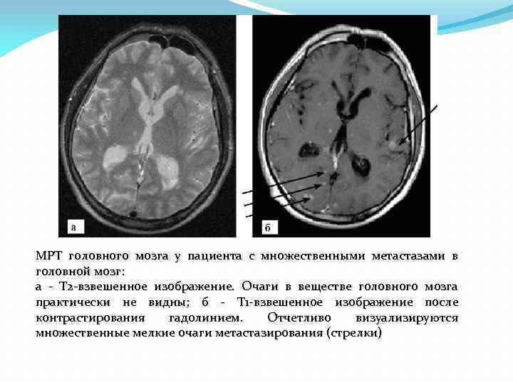 Т2 взвешенное изображение