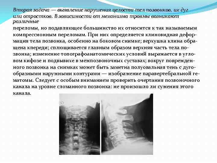 Вторая задача — выявление нарушения целости тел позвонков, их дуг или отростков. В зависимости