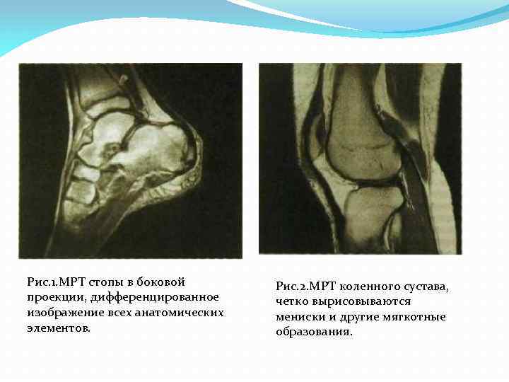 Мрт стопы