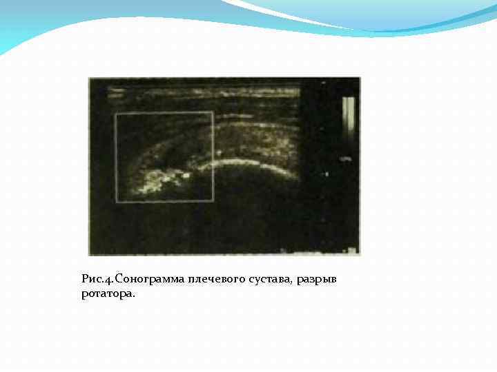 Рис. 4. Сонограмма плечевого сустава, разрыв ротатора. 