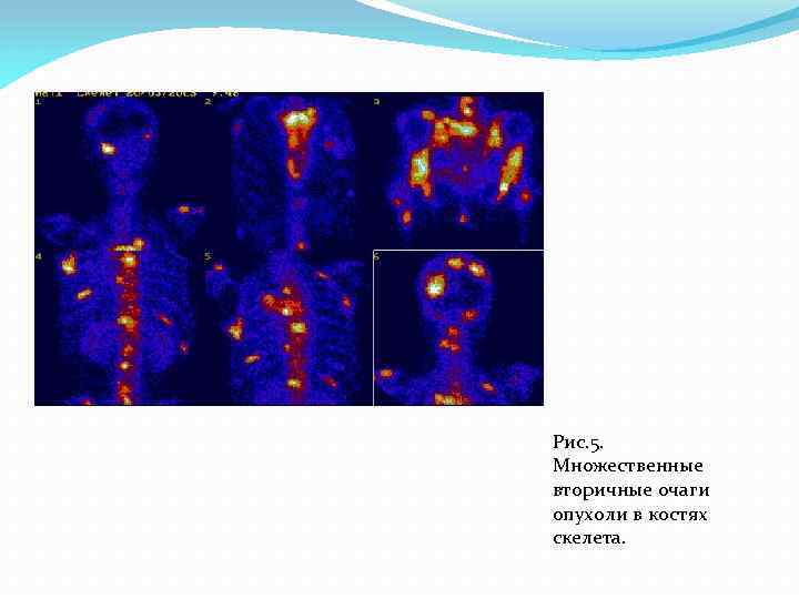 Рис. 5. Множественные вторичные очаги опухоли в костях скелета. 