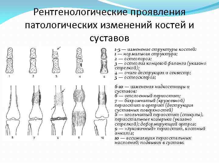 Изменения костей