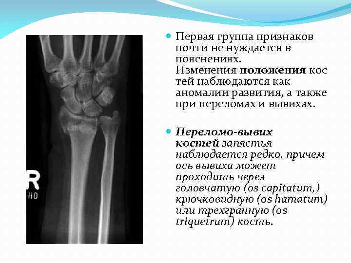 Положение костей. Вывих трапециевидной кости. Подвывих трапециевидной кости. Подвывих кости трапеции. Вывихи костей запястья-кость трапеция.