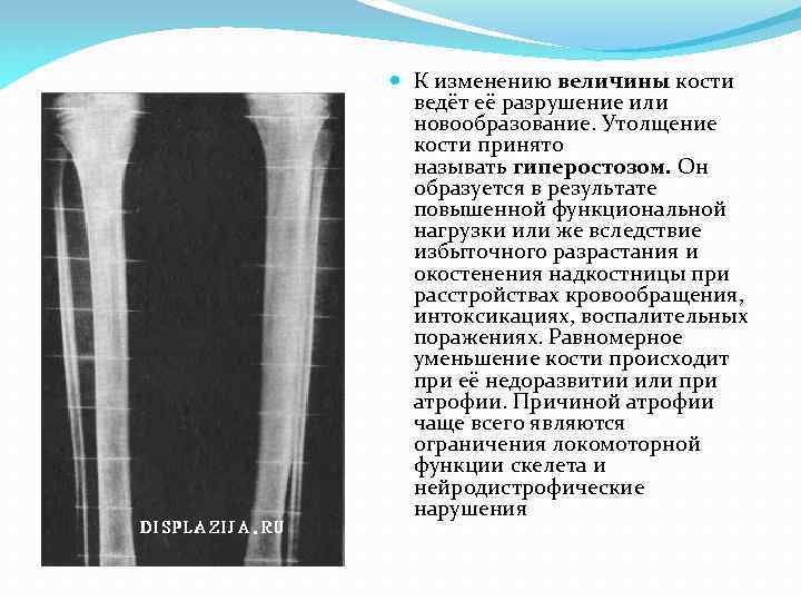 Кости примем. Гиперостоз костей рентген. Гиперостоз плечевой кости. Локальный гиперостоз большеберцовой кости.